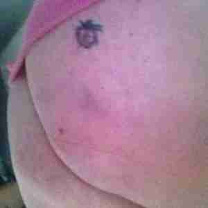 sore bum got spanked took nearly 2 weeks for the bruise to go bum spnked